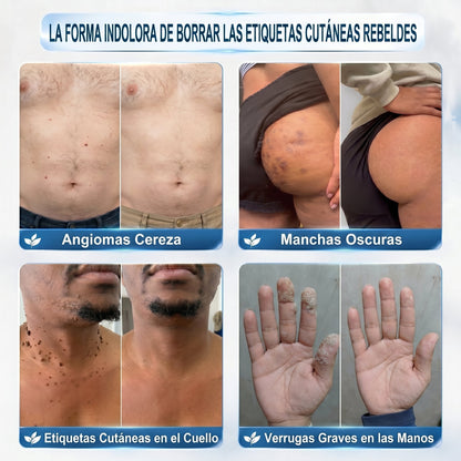 𝐏𝐢𝐜𝐝𝐨® 🍇🍇 Borrador de Verrugas y Manchas en 7 Días (𝐀𝐩𝐥𝐢𝐜𝐚𝐝𝐨𝐫 𝐫𝐨𝐥𝐥-𝐨𝐧: 𝐬𝐢𝐧 𝐝𝐨𝐥𝐨𝐫 𝐧𝐢 𝐜𝐢𝐜𝐚𝐭𝐫𝐢𝐜𝐞𝐬)✨