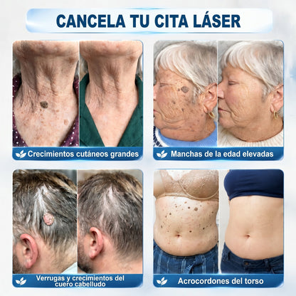 𝐏𝐢𝐜𝐝𝐨® 🍇🍇 Borrador de Verrugas y Manchas en 7 Días (𝐀𝐩𝐥𝐢𝐜𝐚𝐝𝐨𝐫 𝐫𝐨𝐥𝐥-𝐨𝐧: 𝐬𝐢𝐧 𝐝𝐨𝐥𝐨𝐫 𝐧𝐢 𝐜𝐢𝐜𝐚𝐭𝐫𝐢𝐜𝐞𝐬)✨